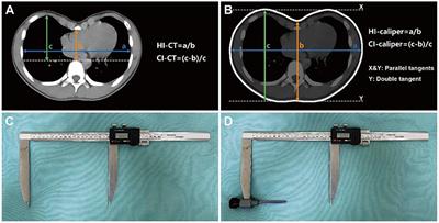 Use of caliper-based external measurement of body surface in assessing the severity of pectus excavatum